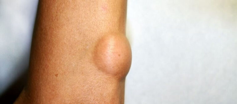 Lipoma Removal Using Liposuction