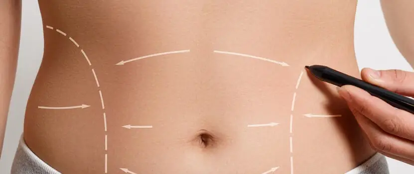 Benefits of Tummy Tucks