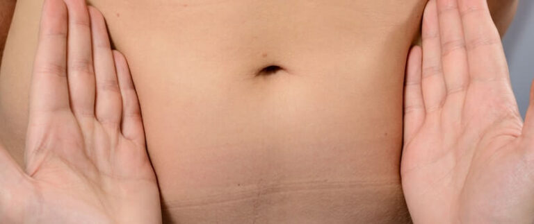 Types of Tummy Tucks: Which Is Right for You?