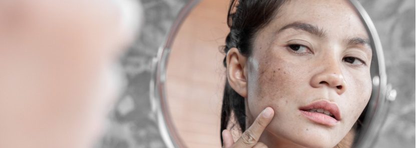 How to Get Rid of Dark Spots on Your Face