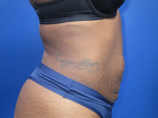 Liposuction Right Side After