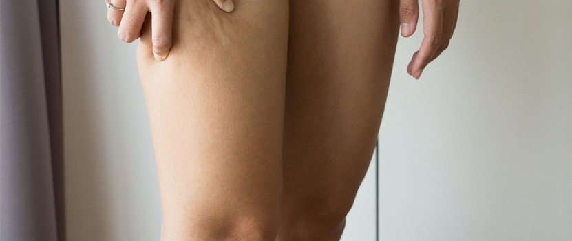 Cellulite on outlet calf