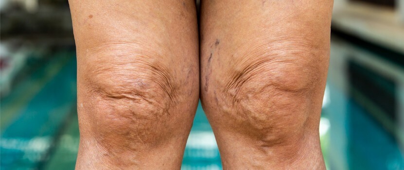 How to Get Rid of Crepey Skin on Legs