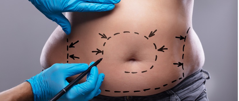 How Does Liposuction Work?