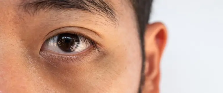 How to Remove Dark Circles Under Eyes Permanently