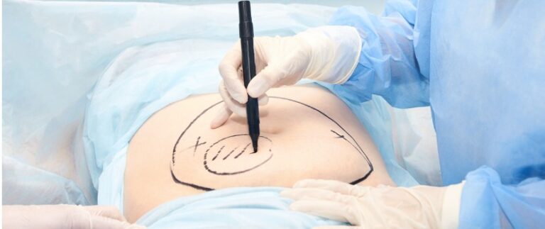 How Long Does Fat Transfer Last?