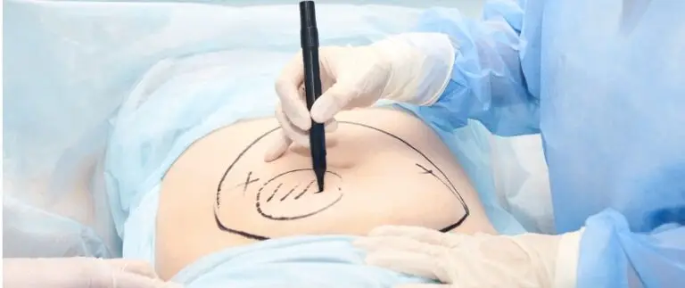 How Long Does Fat Transfer Last?