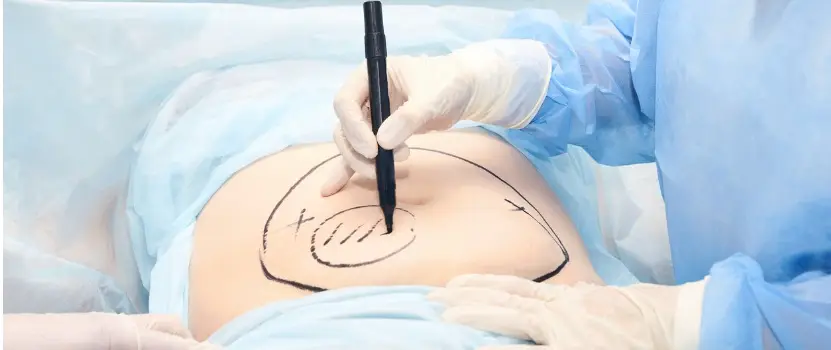 How Long Does Fat Transfer Last?