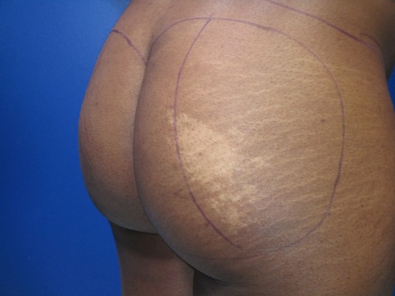 Fat Transfer Right Buttocks Before