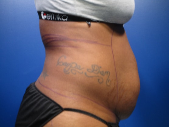 Liposuction Right Side Before