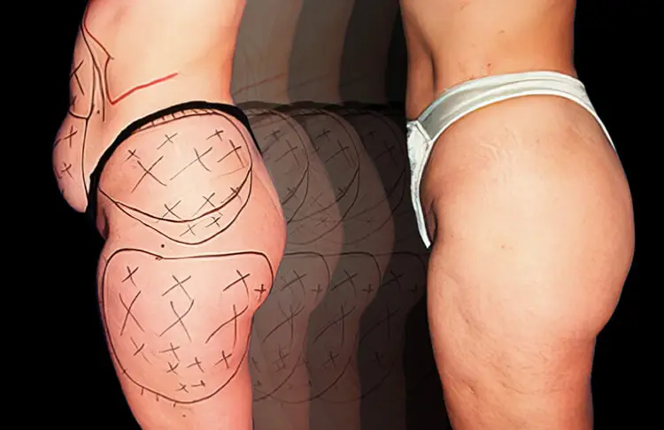 Side-by-side comparison of a person’s hip and buttocks before and after body sculpting, showing surgical markings on the left and a smoother appearance on the right.