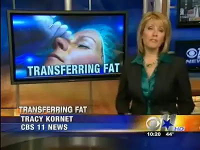 Dr bill johnson innovations medical featured on cbs 11 news dallas for his new fami facelift facial fat transfer surgery.