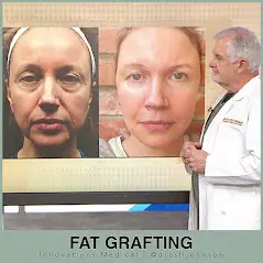 Fat Transfer Surgery on the face using the FAMI technique, Dr. Bill Johnson