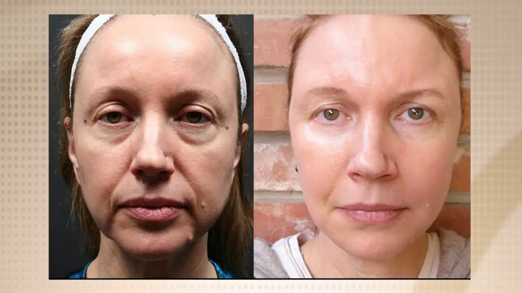 Before and after facial fat transfer using the FAMI technique on female patient to restore volume in cheeks, under-eyes, and jawline