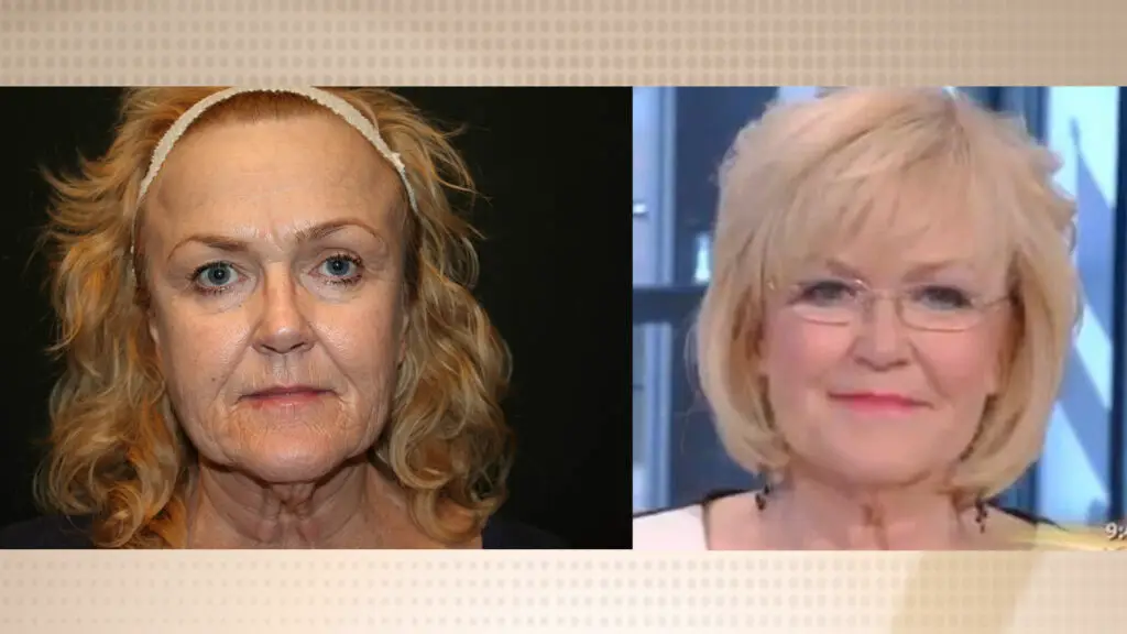 Before and after facial fat transfer using the FAMI technique on female patient to restore volume in cheeks, under-eyes, and jawline