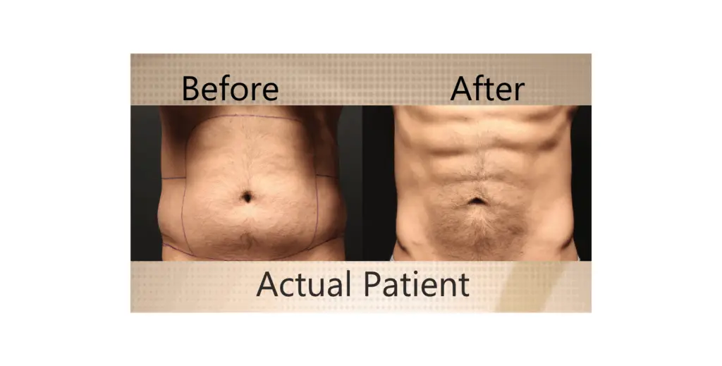 Lose belly fat - Male belly before and after