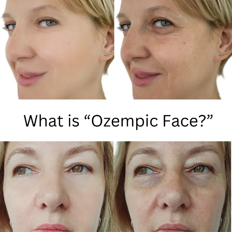 Ozempic Face