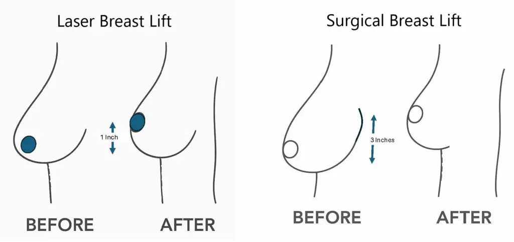 Laser Breast Lift