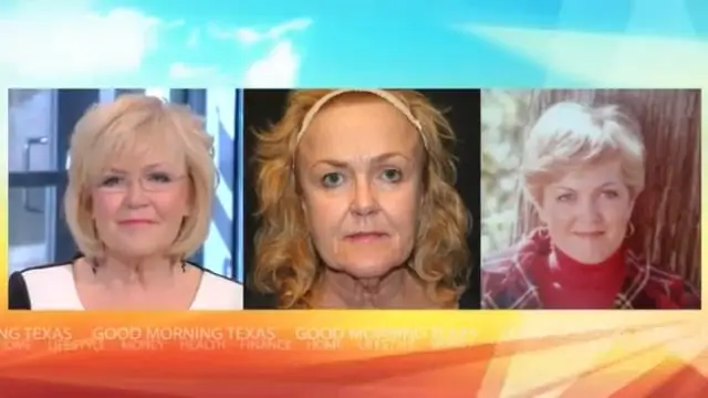 FAMI face lift patient testimonial Good Morning Texas Dr Bill Johnson Dallas